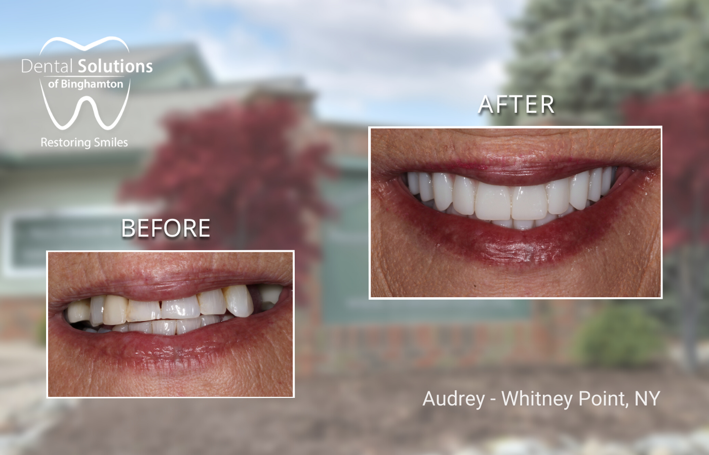 Full Arch Implants Binghamton, NY