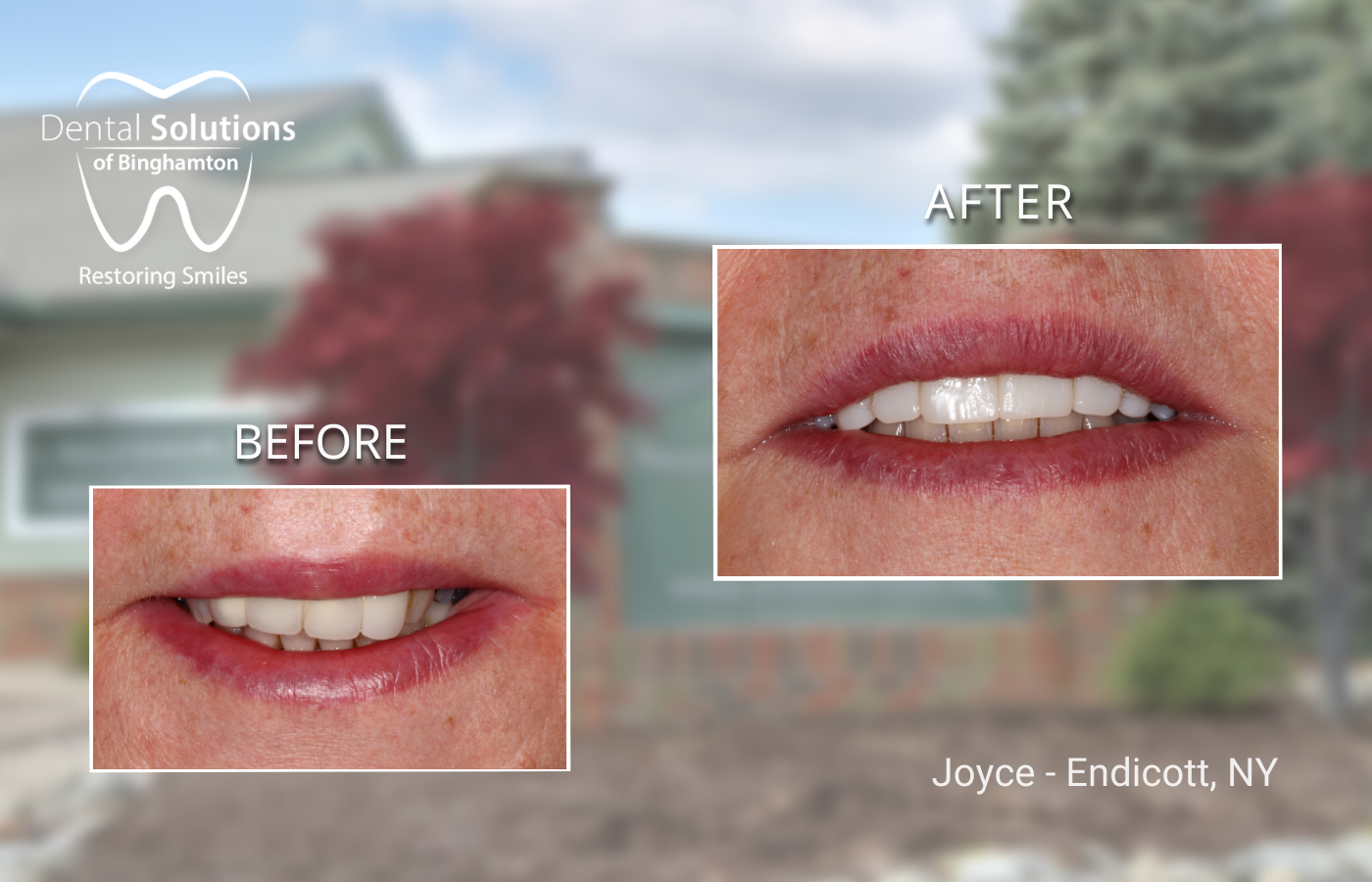 Full Mouth Rehabilitation